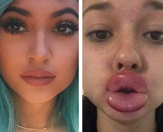 Kylie Jenner Lip Challenge
